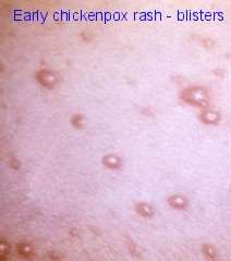 Diamond Tv Xxx Chicken Pox Adult Symptoms